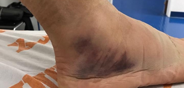 Bokaficam és teendők a fasciaháló szemszögéből