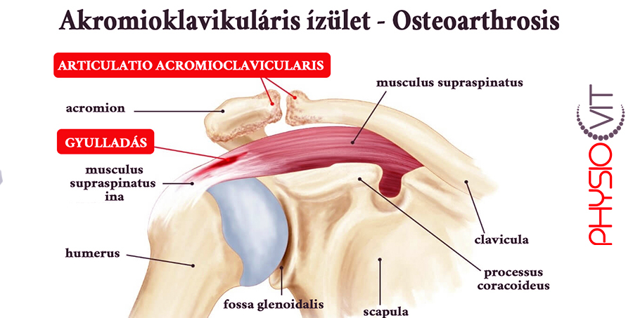 Hogyan kezelhető az akromioklavikuláris (AC) ízületi kopás? – Útmutató a fájdalom csökkentéséhez és a mozgás szabadságához